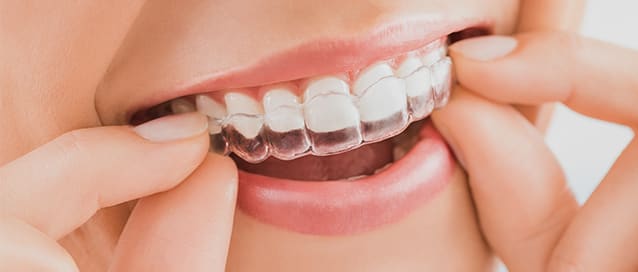 Invisalign, Toothworks Dental Clinics
