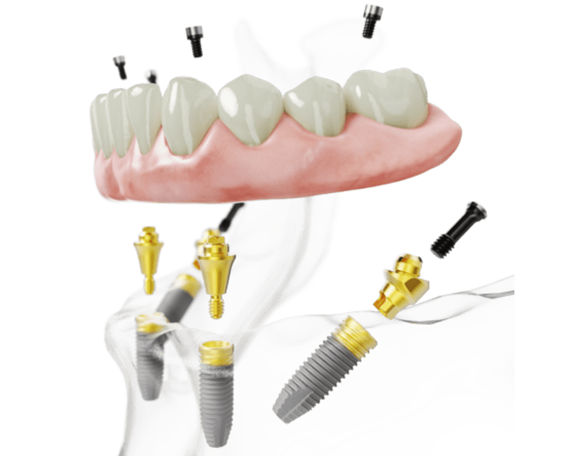 Implants dentaires, Dentiste à Victoria