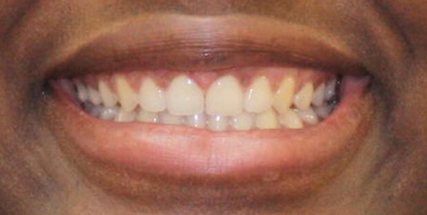 Patient 1 After Invisalign Treatment.