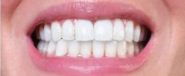 Patient 2 After Invisalign Treatment.