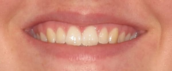 Patient 3 After Invisalign Treatment.