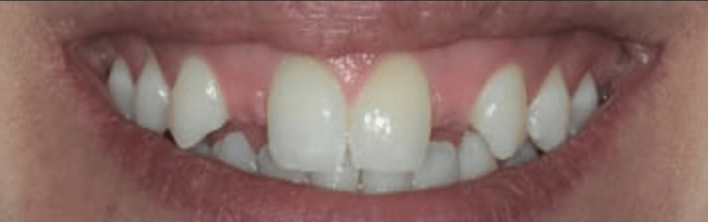 Dental Implant
