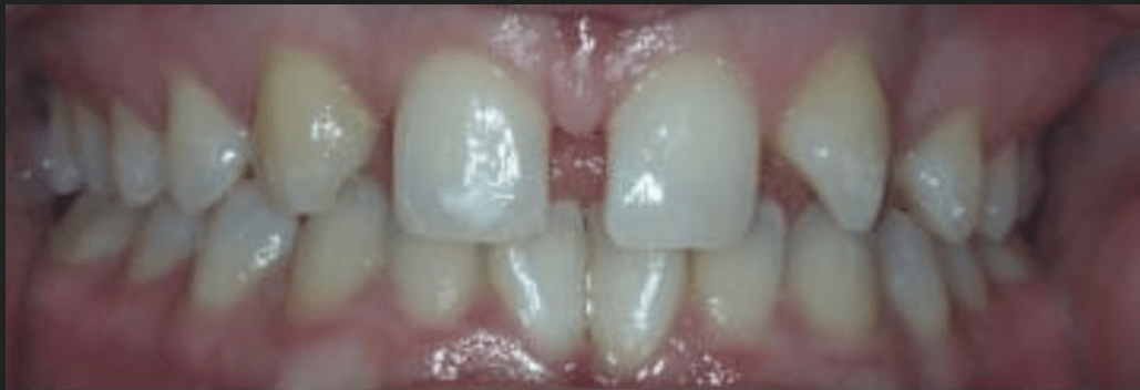 Dental Implants Before & After