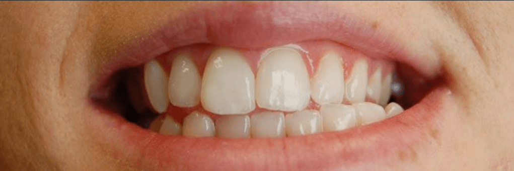 Invisalign Before & After