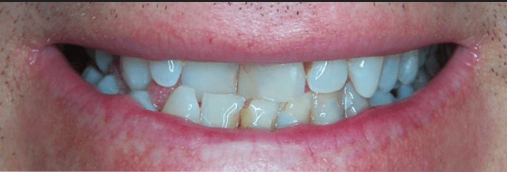 Invisalign Before & After