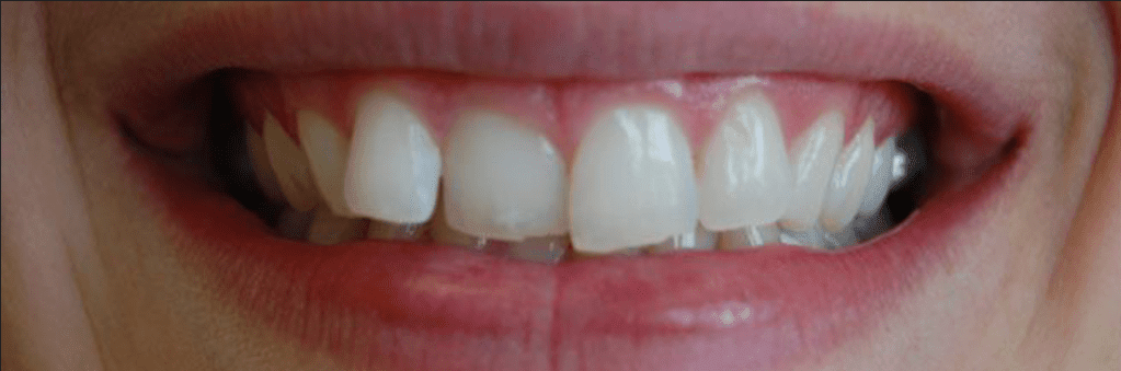 Invisalign Before & After