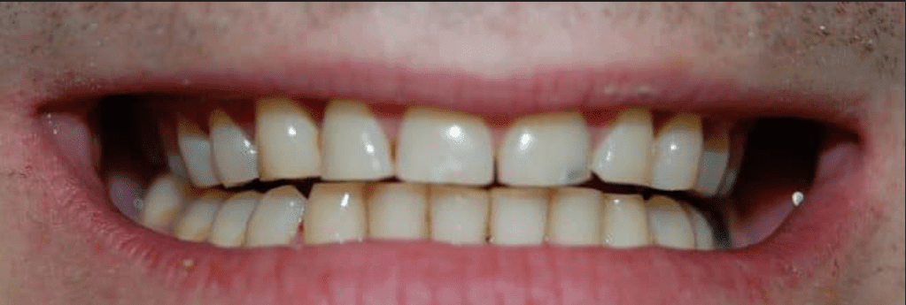 Invisalign Before & After