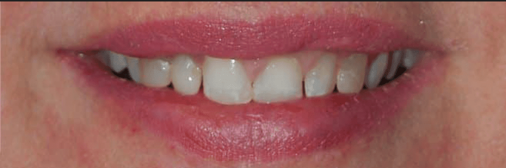 Invisalign Before & After