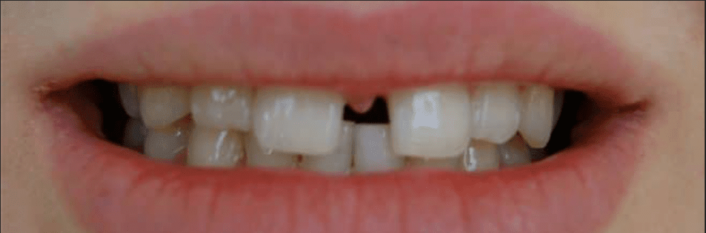 Invisalign Before & After
