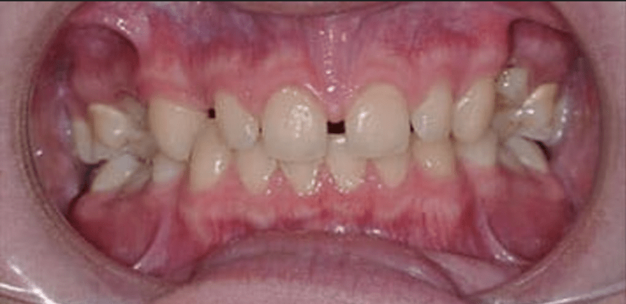 Non-Prep Veneers Before & After