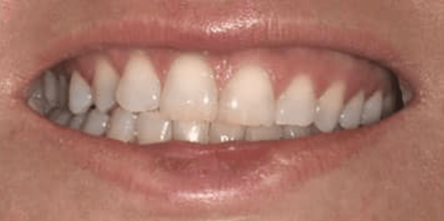 Non-Prep Veneers Before & After