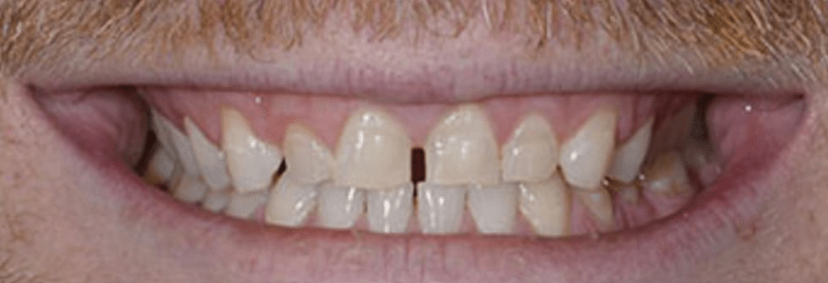 Non-Prep Veneers Before & After