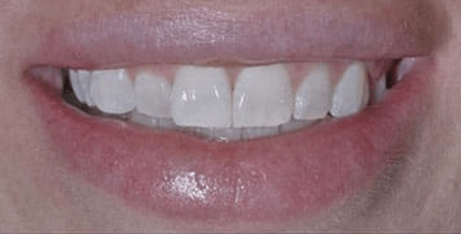 Non-Prep Veneers Before & After