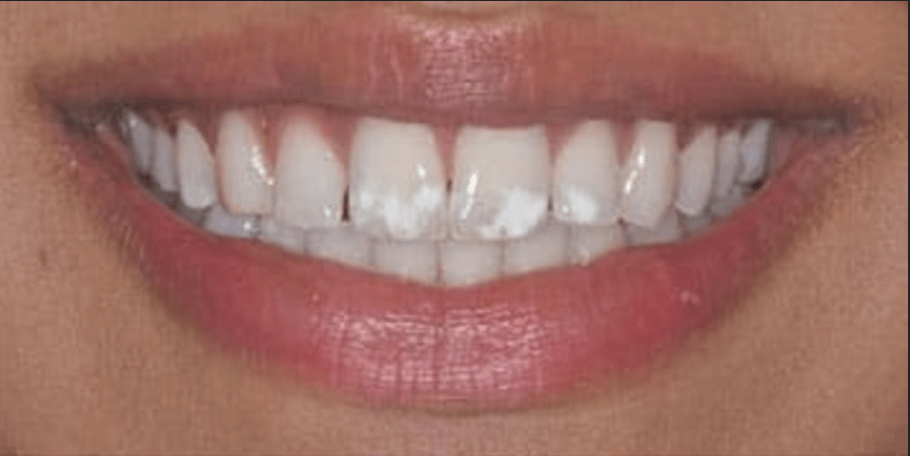 Non-Prep Veneers Before & After