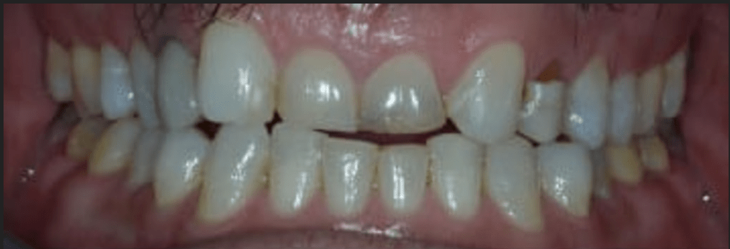 Smile Makeover Before & After