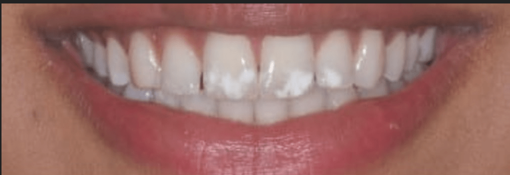Smile Makeover Before & After