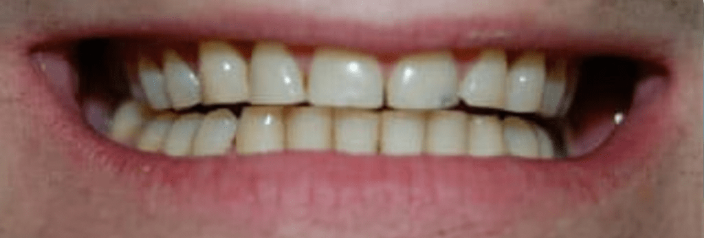 Smile Makeover Before & After