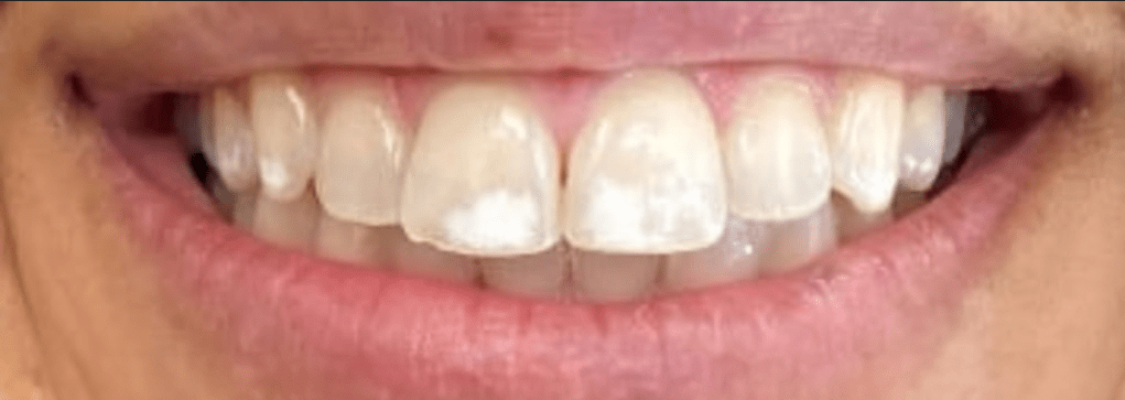 Smile Makeover Before & After