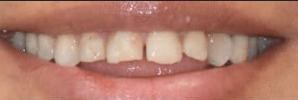 Teeth-in-a-Day Before & After