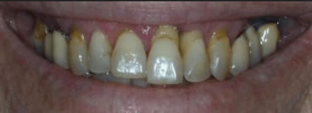 Teeth-in-a-Day Before & After