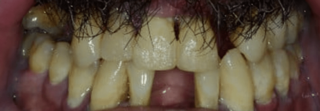 Teeth-in-a-Day Before & After