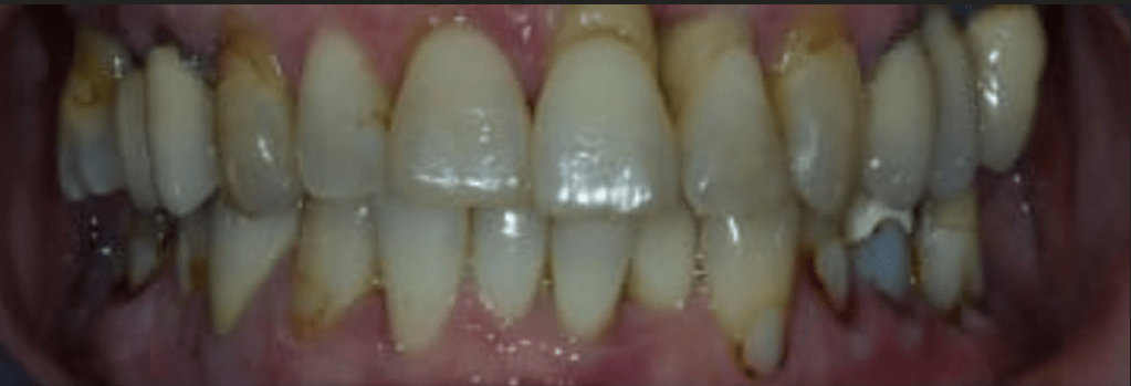 Teeth-in-a-Day Before & After
