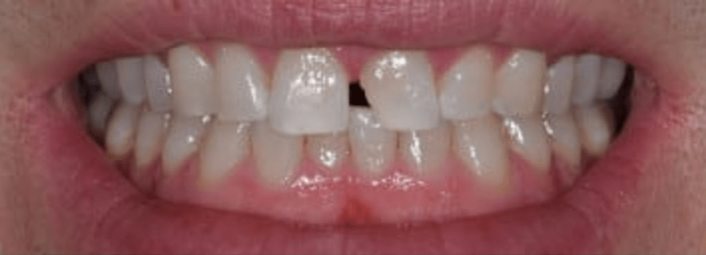 Porcelain Veneers Before & After