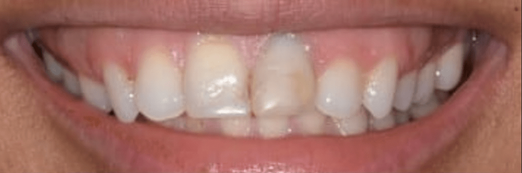 Porcelain Veneers Before & After
