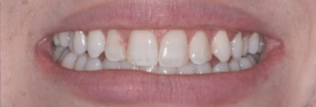 Porcelain Veneers Before & After