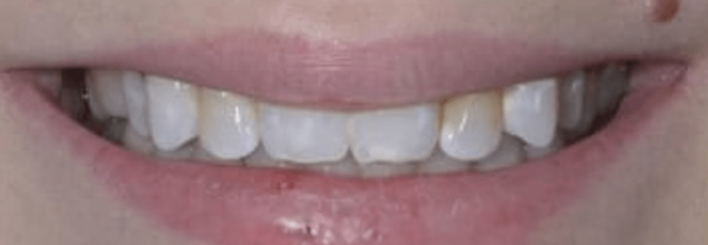 Porcelain Veneers Before & After