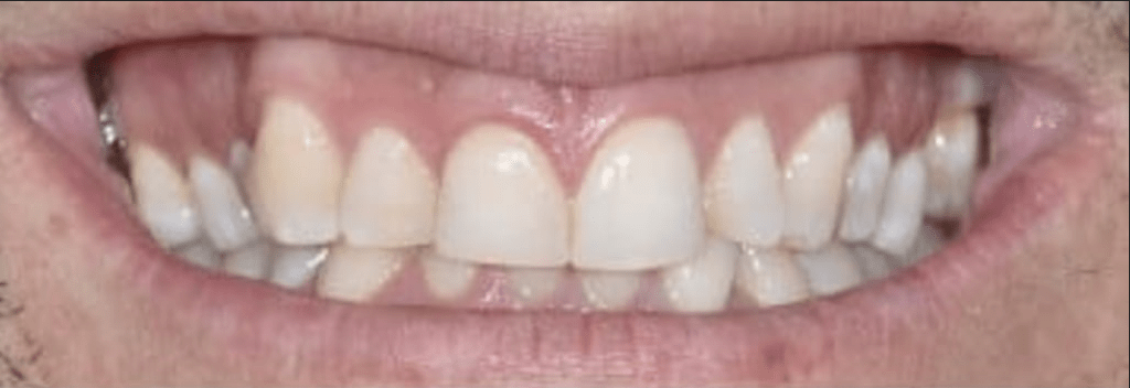 Porcelain Veneers Before & After