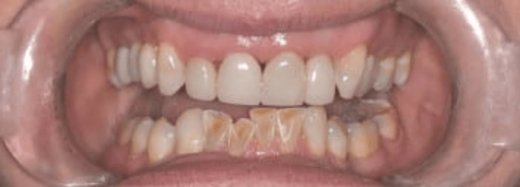 Porcelain Veneers Before & After