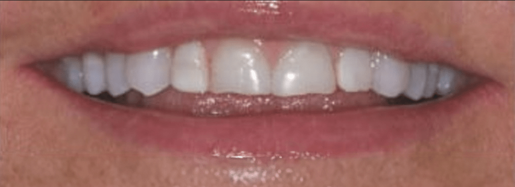 Porcelain Veneers Before & After