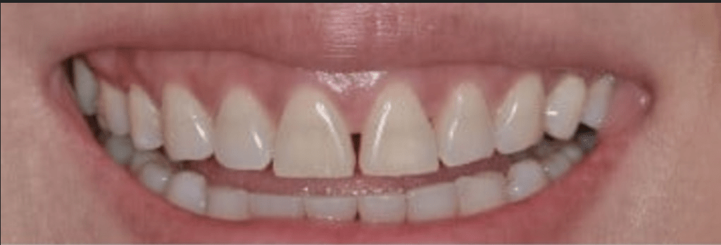 Porcelain Veneers Before & After