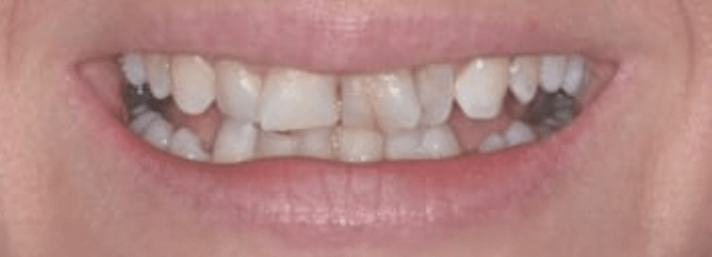 Porcelain Veneers Before & After