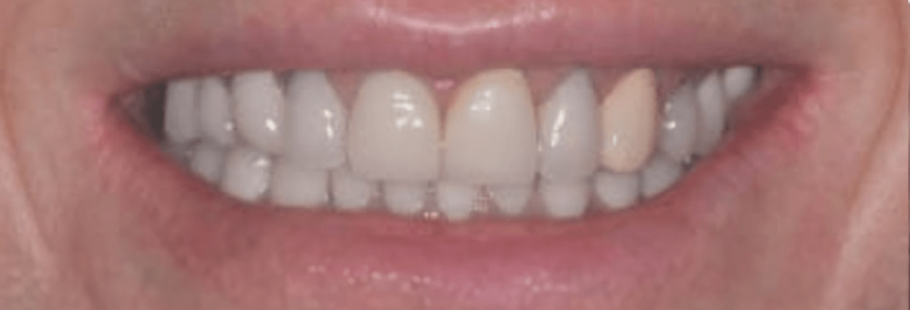 Porcelain Veneers Before & After