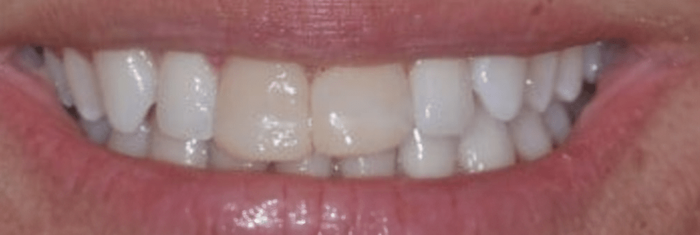 Porcelain Veneers Before & After