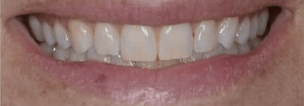 Porcelain Veneers Before & After