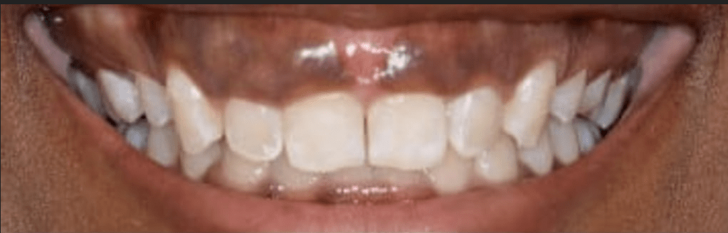 Porcelain Veneers Before & After