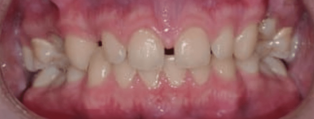Porcelain Veneers Before & After