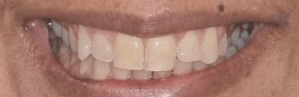 Porcelain Veneers Before & After