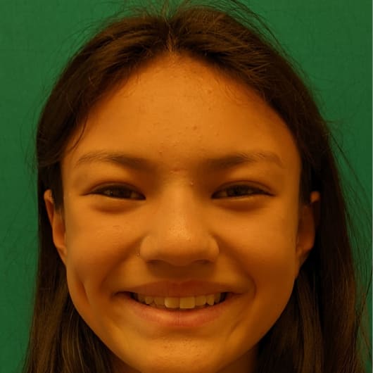 Patient Photo Before Treatment at All Star Smiles Orthodontics