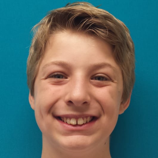 Patient Photo Before Treatment at All Star Smiles Orthodontics
