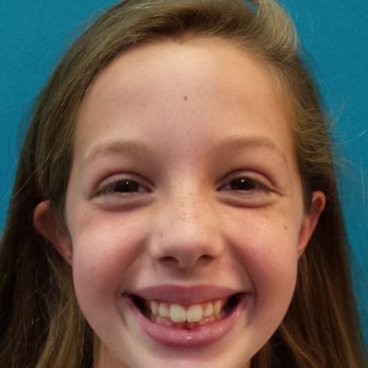 Patient Photo Before Treatment at All Star Smiles Orthodontics
