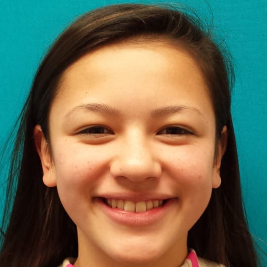 Patient Photo Before Treatment at All Star Smiles Orthodontics