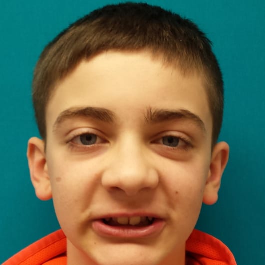 Patient Photo Before Treatment at All Star Smiles Orthodontics