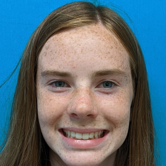 Patient Photo Before Treatment at All Star Smiles Orthodontics