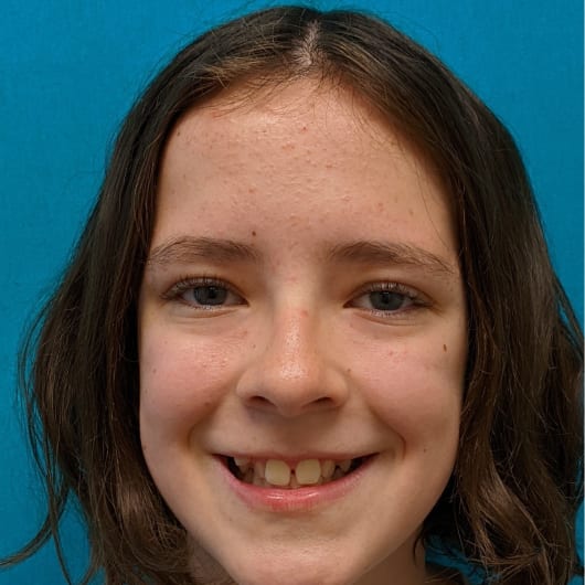 Patient Photo Before Treatment at All Star Smiles Orthodontics