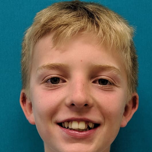 Patient Photo Before Treatment at All Star Smiles Orthodontics