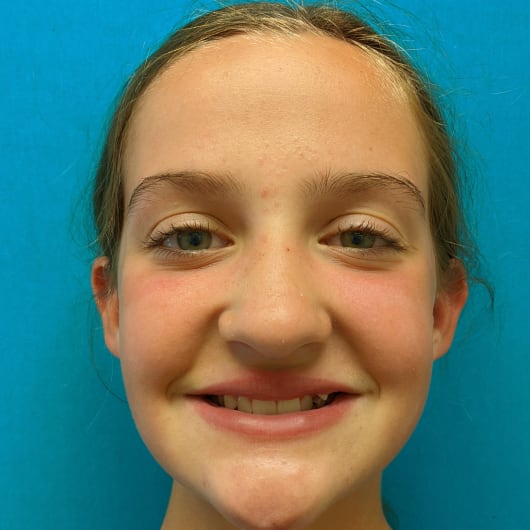 Patient Photo Before Treatment at All Star Smiles Orthodontics